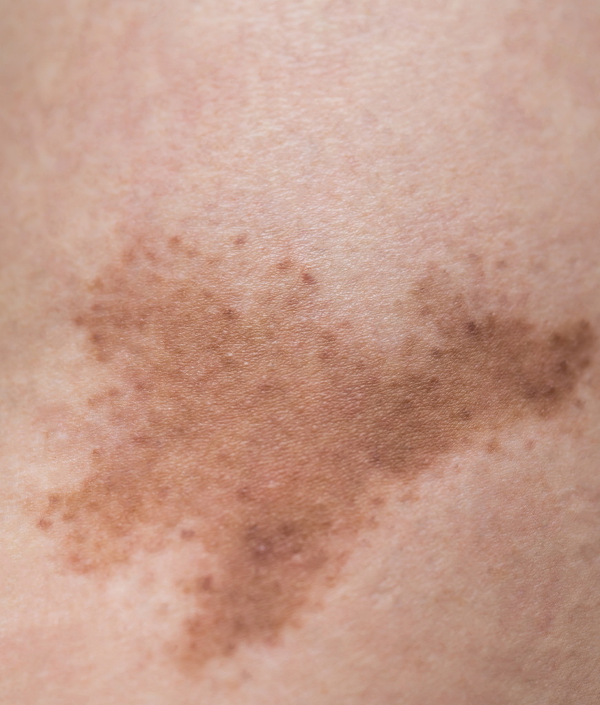 Hyperpigmentation on the skin