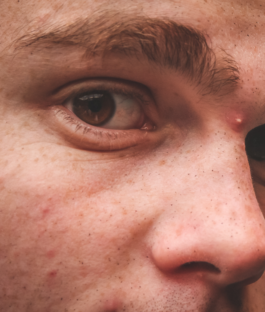 Acne on a man's face