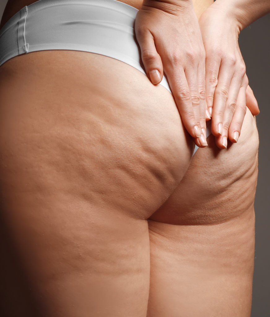 Cellulite on a woman's buttocks