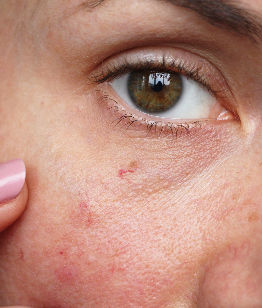 Close-up on facial redness