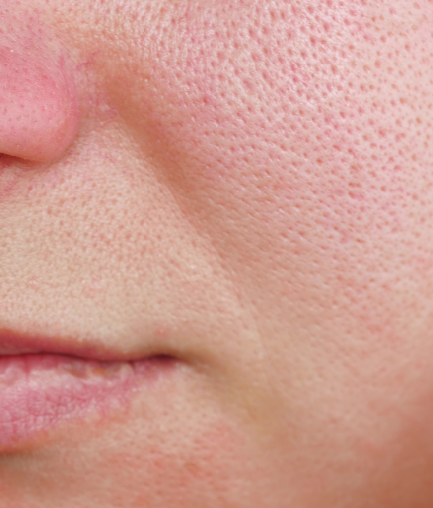 Close-up on large pores