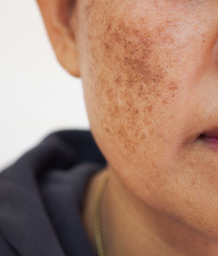 Melasma on a person's face