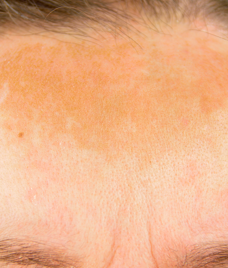 Sun damage on a woman's forehead