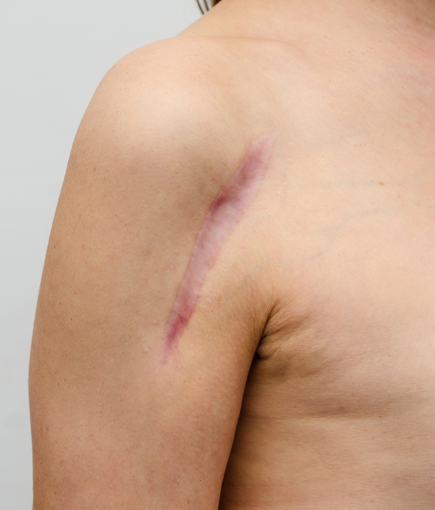 Surgical scars on a man's body