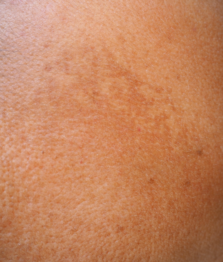 types-of-skin-discoloration