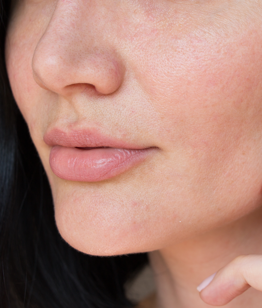 Close-up on a woman's face with skin tone and texture issues