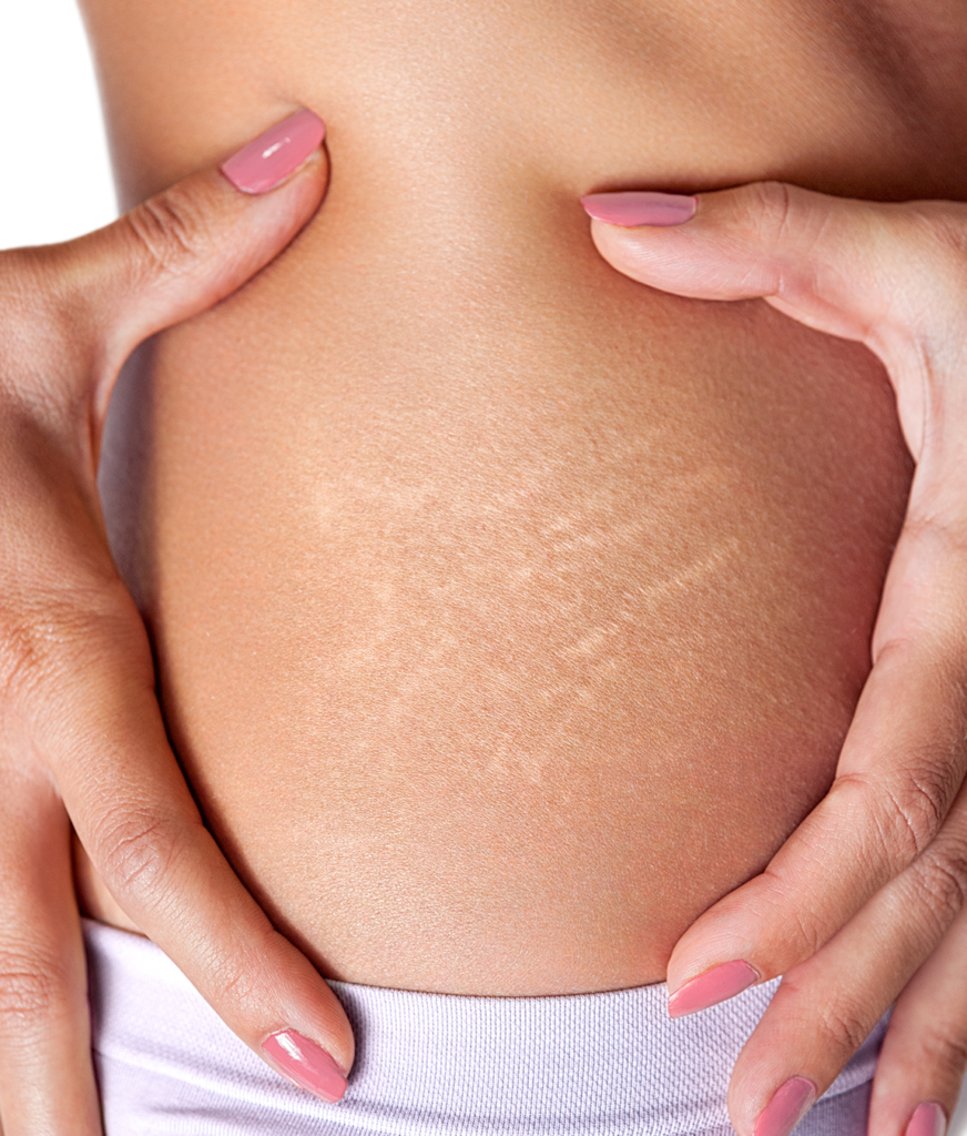 Close-up on stretch marks