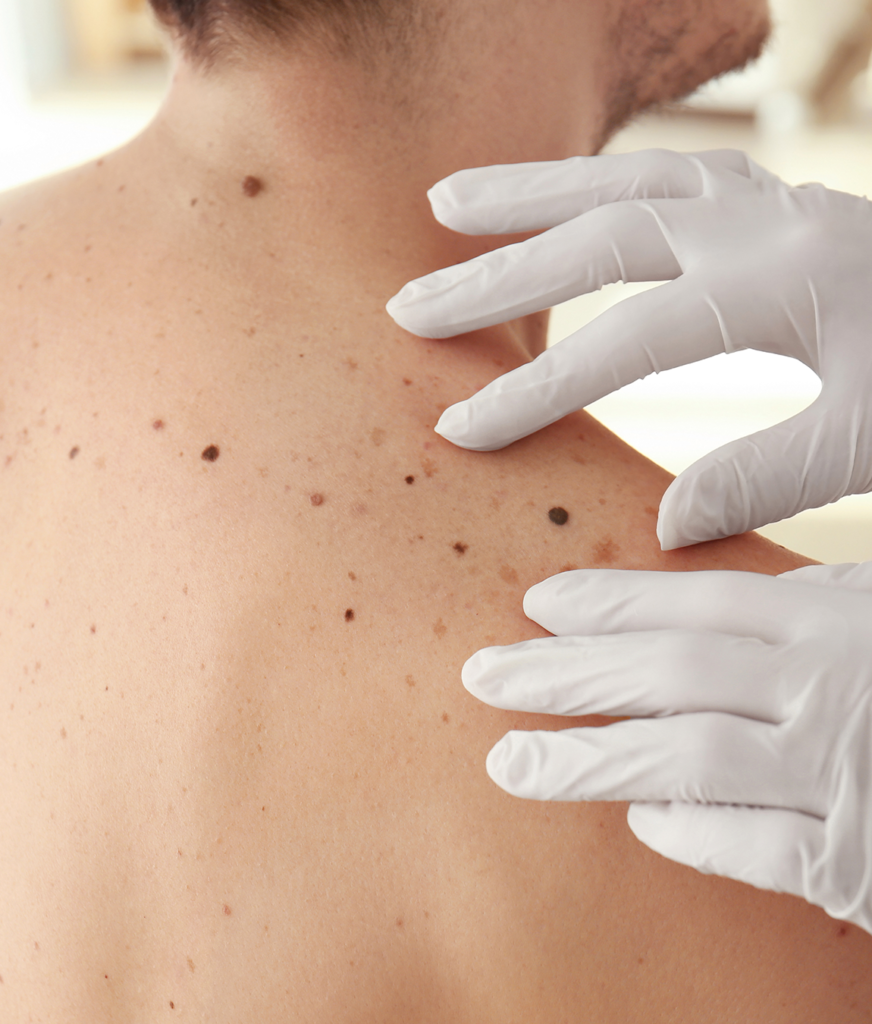 Moles and sun damage on a man's back