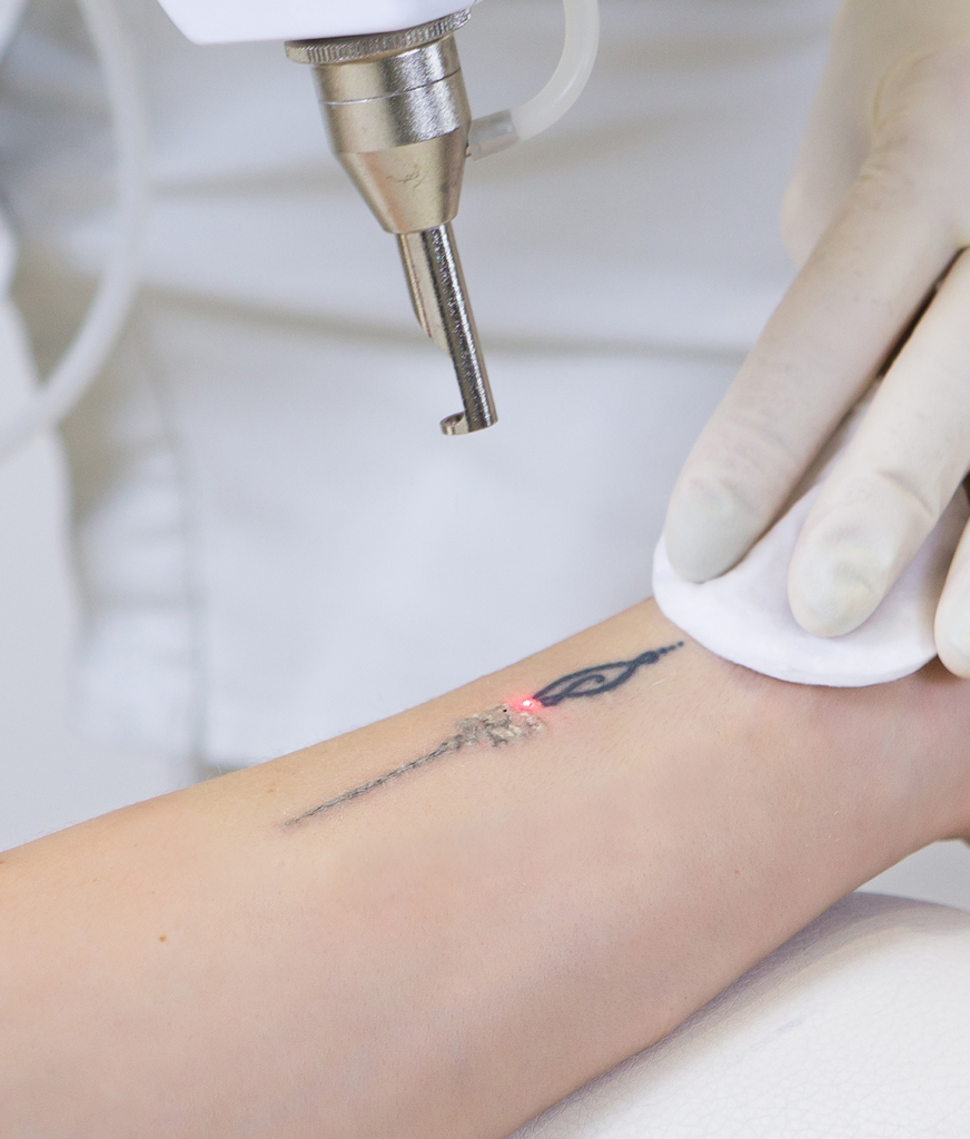 Laser treatment for unwanted tattoos